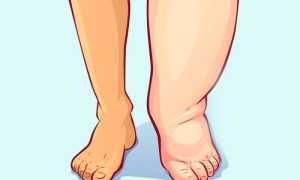 Почему отекают ноги и как избавиться от отечности: советы и рекомендации