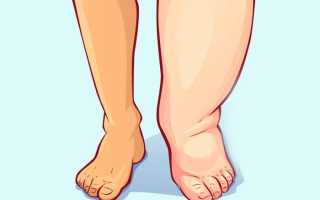 Почему отекают ноги и как избавиться от отечности: советы и рекомендации