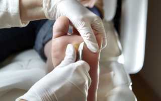 Практические способы как избавиться от мозолей на ногах