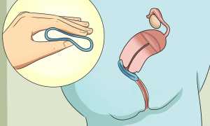 Новаринг – отзывы девушек о вагинальном кольце и его особенностях