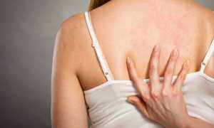 Что такое крапивница и как от нее избавиться: полезные советы