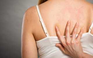 Что такое крапивница и как от нее избавиться: полезные советы