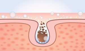 Эффективные способы как самостоятельно убрать черные точки на носу в домашних условиях