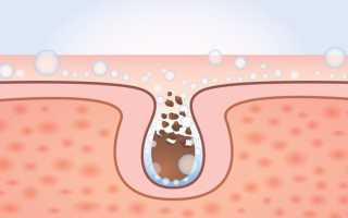 Эффективные способы как самостоятельно убрать черные точки на носу в домашних условиях