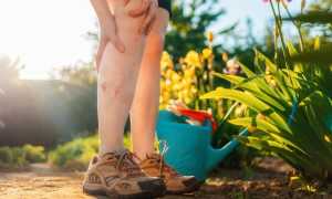 Как бороться с сосудистыми звездочками на ногах: советы и рекомендации