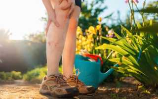 Как бороться с сосудистыми звездочками на ногах: советы и рекомендации