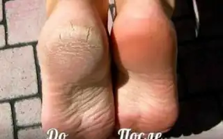 Перекись водорода для пяточек