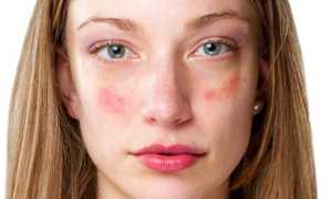 Как убрать пятна от прыщей на лице быстро и эффективно