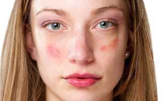 Как убрать пятна от прыщей на лице быстро и эффективно