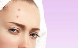 Как очистить кожу лица и избавиться от прыщей навсегда