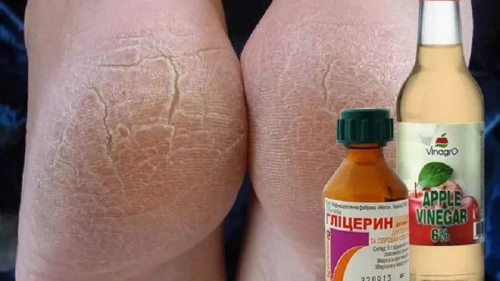 Глицерин с уксусом