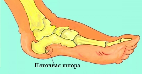 От пяточной шпоры