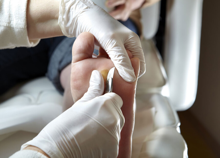 как избавиться от мозолей