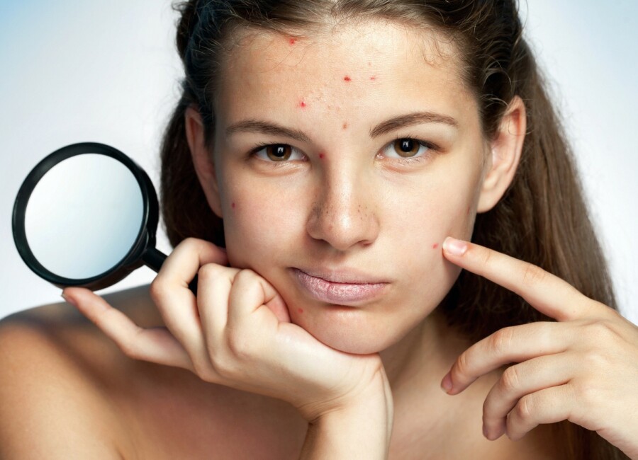 Как убрать пятна от прыщей