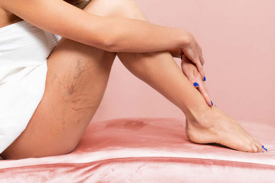 сосудистые звездочки