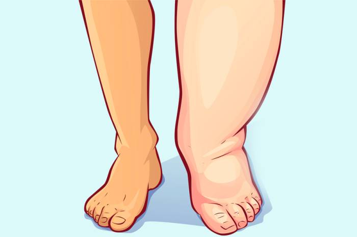 Причина отеков ног