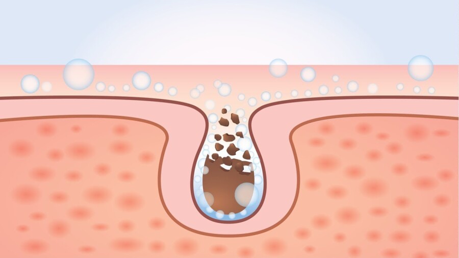 как убрать черные точки на носу